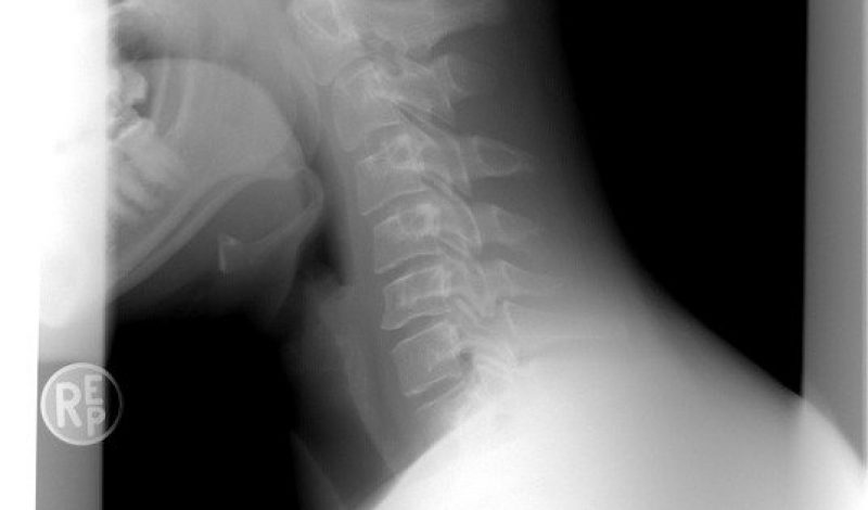 Cervicle Spine Xray image, Skelian Chiropractic Clinic