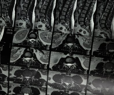 Disc injuries Cheltenham
